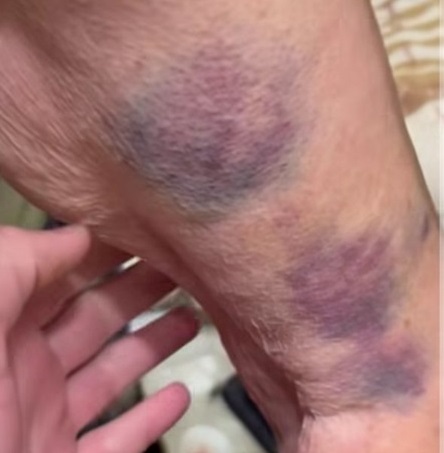 Забої у літньої жінки